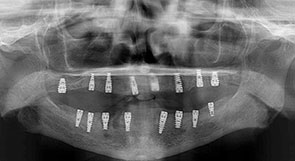 Dental Implants